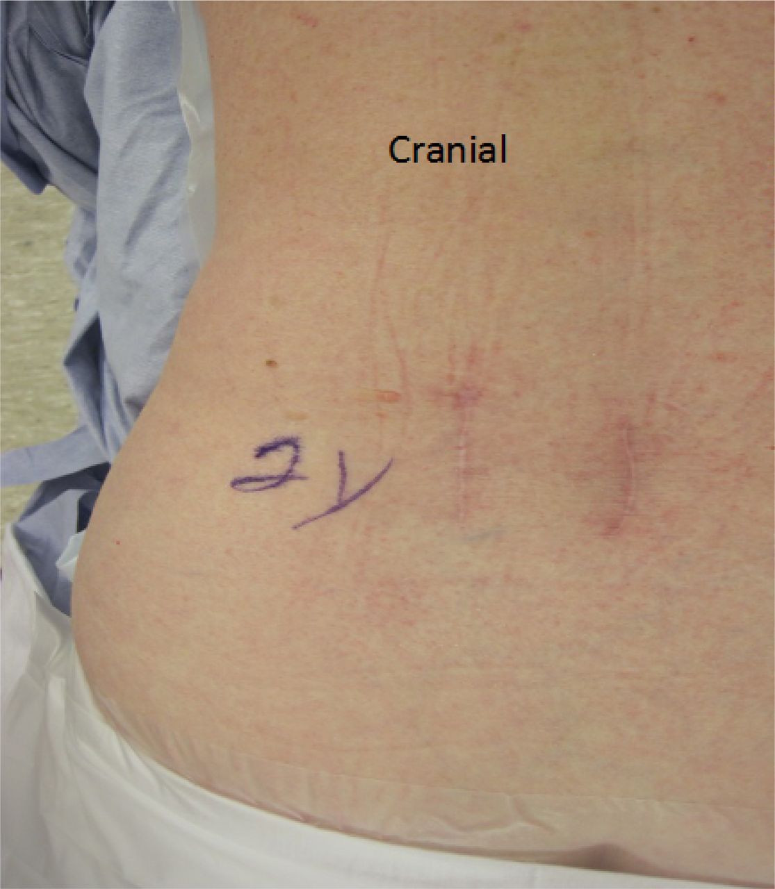 Fig. 7 | The Surgical Treatment of Single Level Multi-Focal Subarticular  and Paracentral and/or Far-Lateral Lumbar Disc Herniations: The Single  Incision Full Endoscopic Approach | International Journal of Spine Surgery