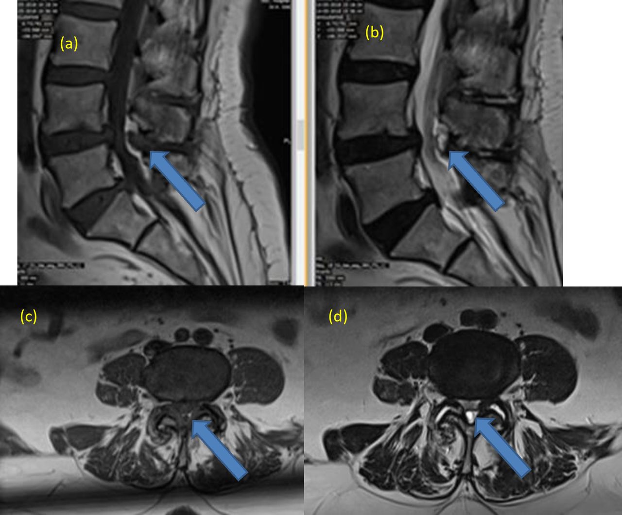 Ligamentum Flavum Cyst With Acute Onset Motor Deficit A Literature