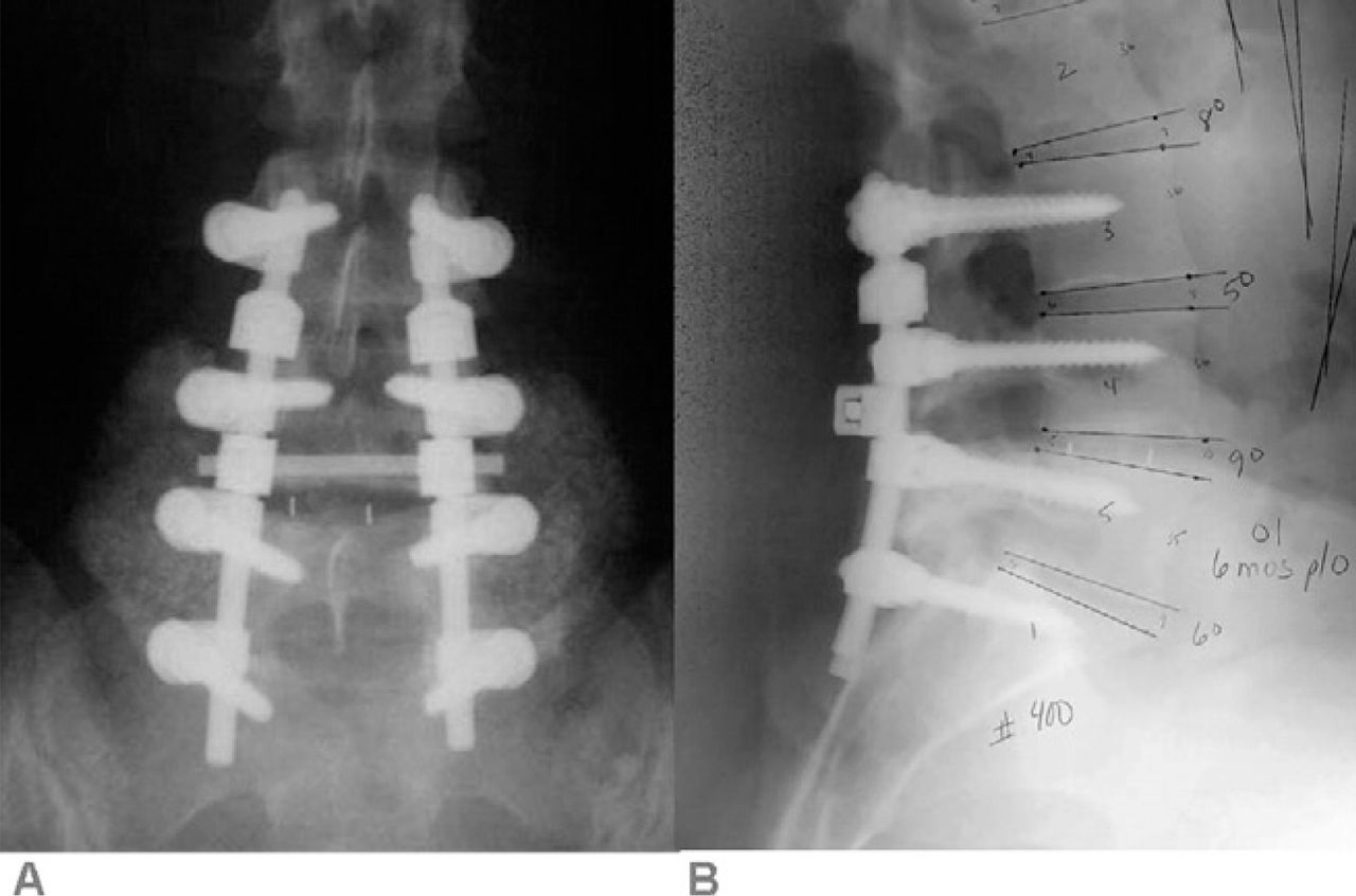 Hybrid Dynamic Stabilization With Posterior Spinal Fusion In The Lumbar