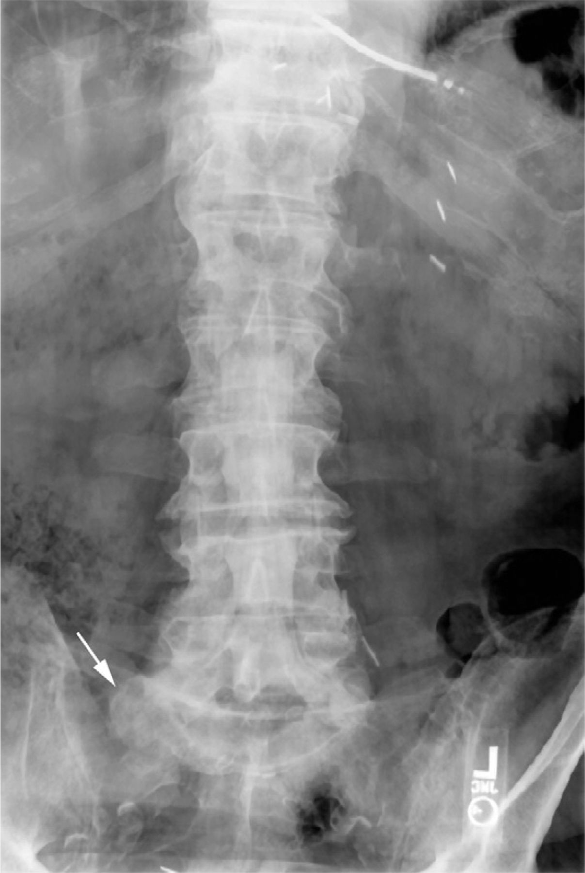 L5 radiculopathy caused by L5 nerve root entrapment by an L5-S1