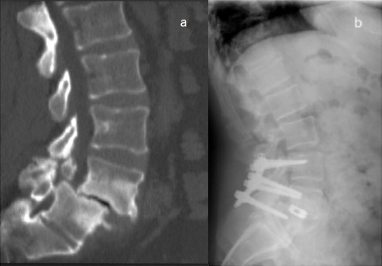 Posterior Lumbar Interbody Fusion With Instrumented Posterolateral