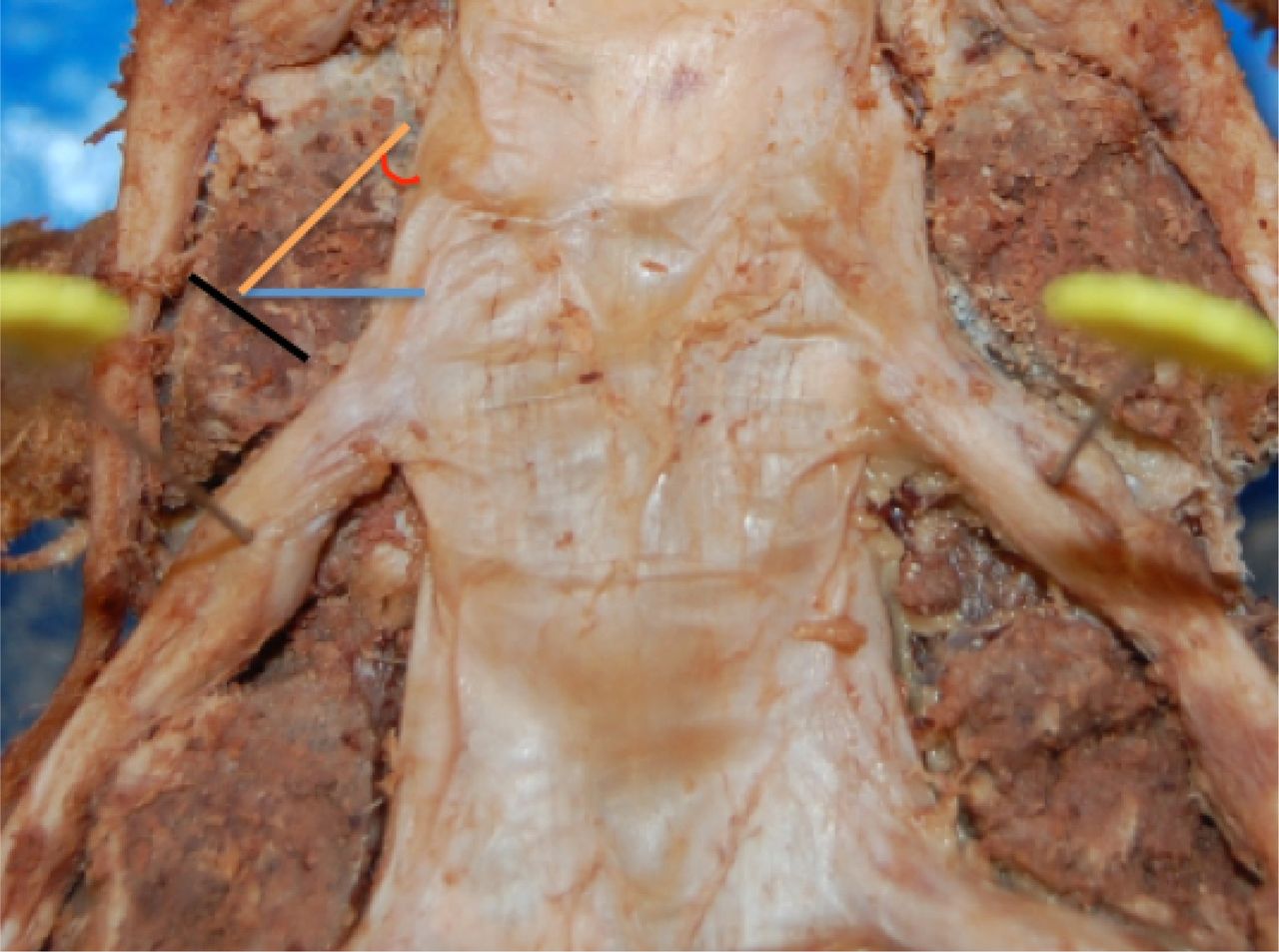 Lumbar Dorsal Root Ganglia Location: An Anatomic and MRI Assessment