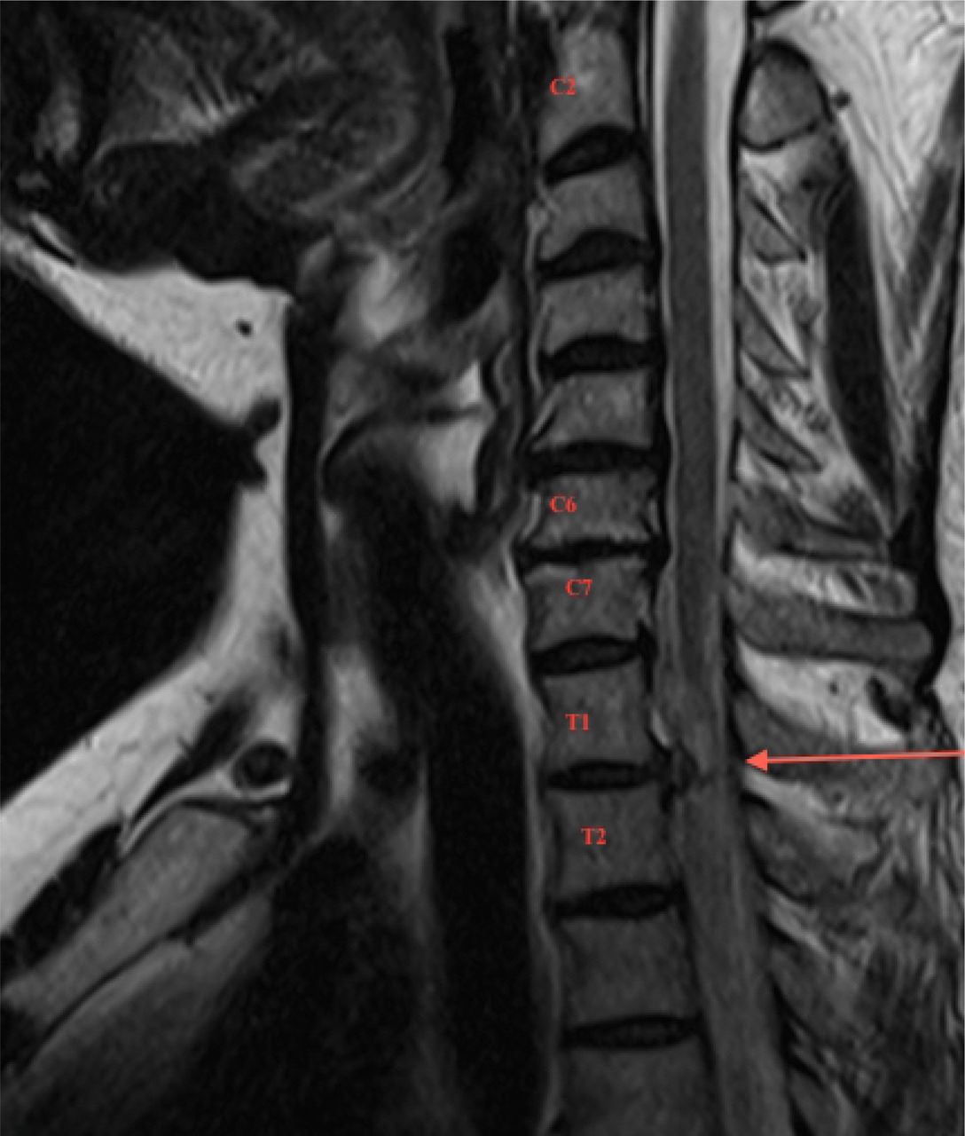 A Rare Case of T1-2 Thoracic Disc Herniation Mimicking Cervical