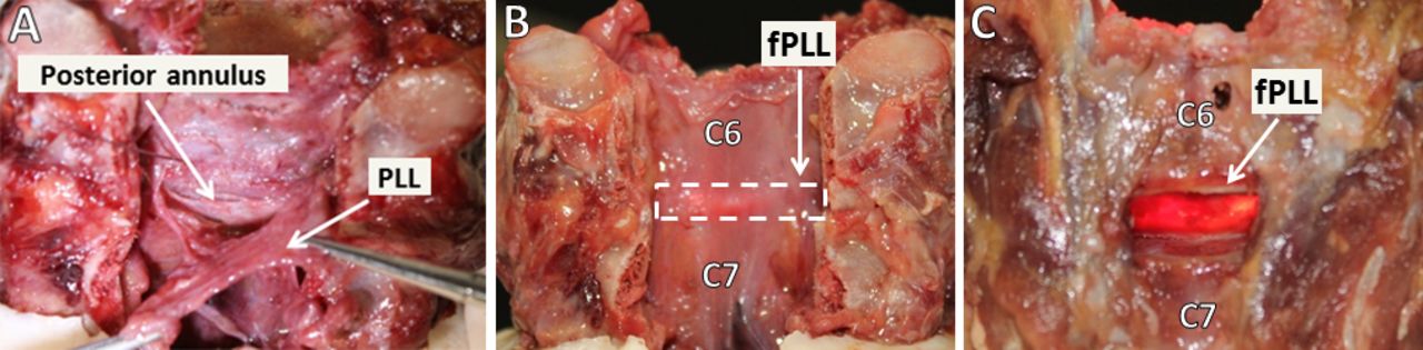 Does Resection of the Posterior Longitudinal Ligament Affect the