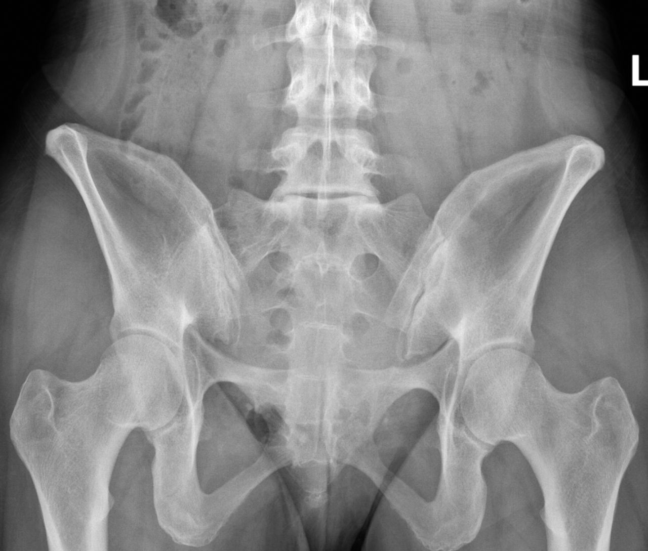 sacrum anatomy xray