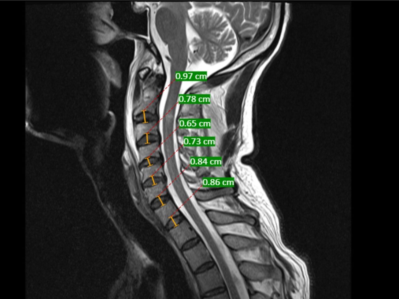 Ligamentum Flavum Hypertrophy Mri