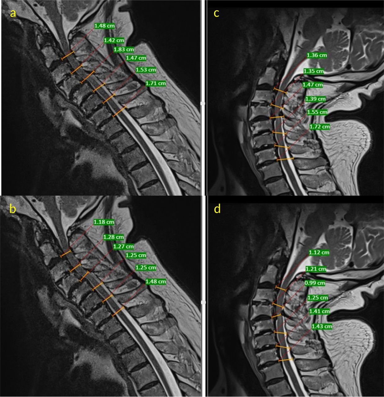 Ligamentum Flavum Cervical Spine