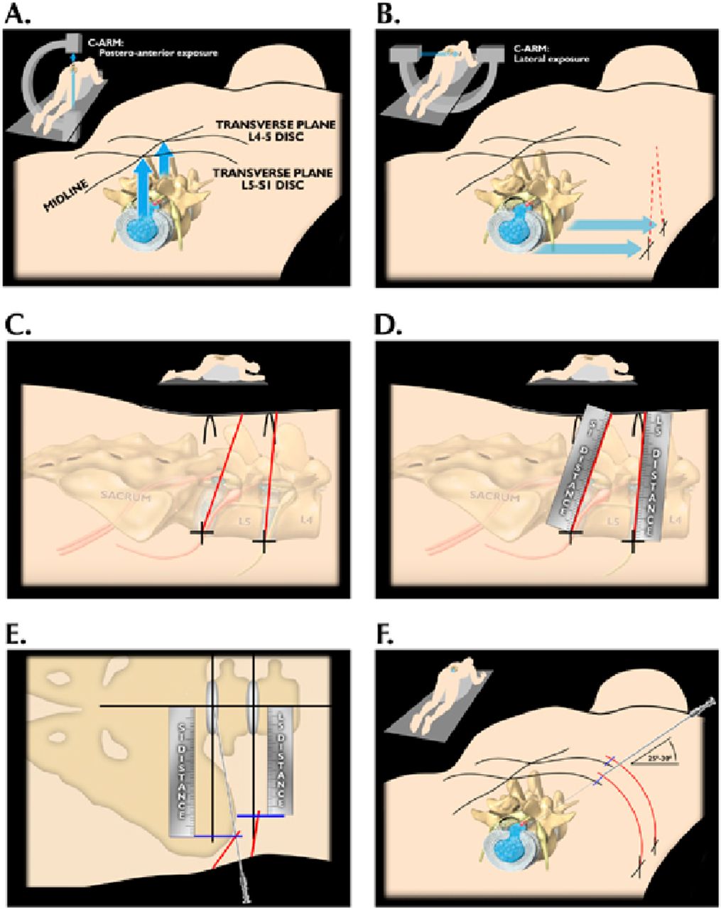 Table 1 from Alternative Treatment of Osteoma Using an Endoscopic Holmium-YAG Laser