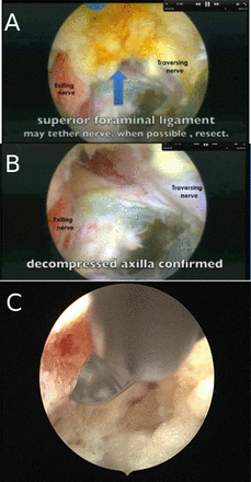 Table 1 from Alternative Treatment of Osteoma Using an Endoscopic  Holmium-YAG Laser