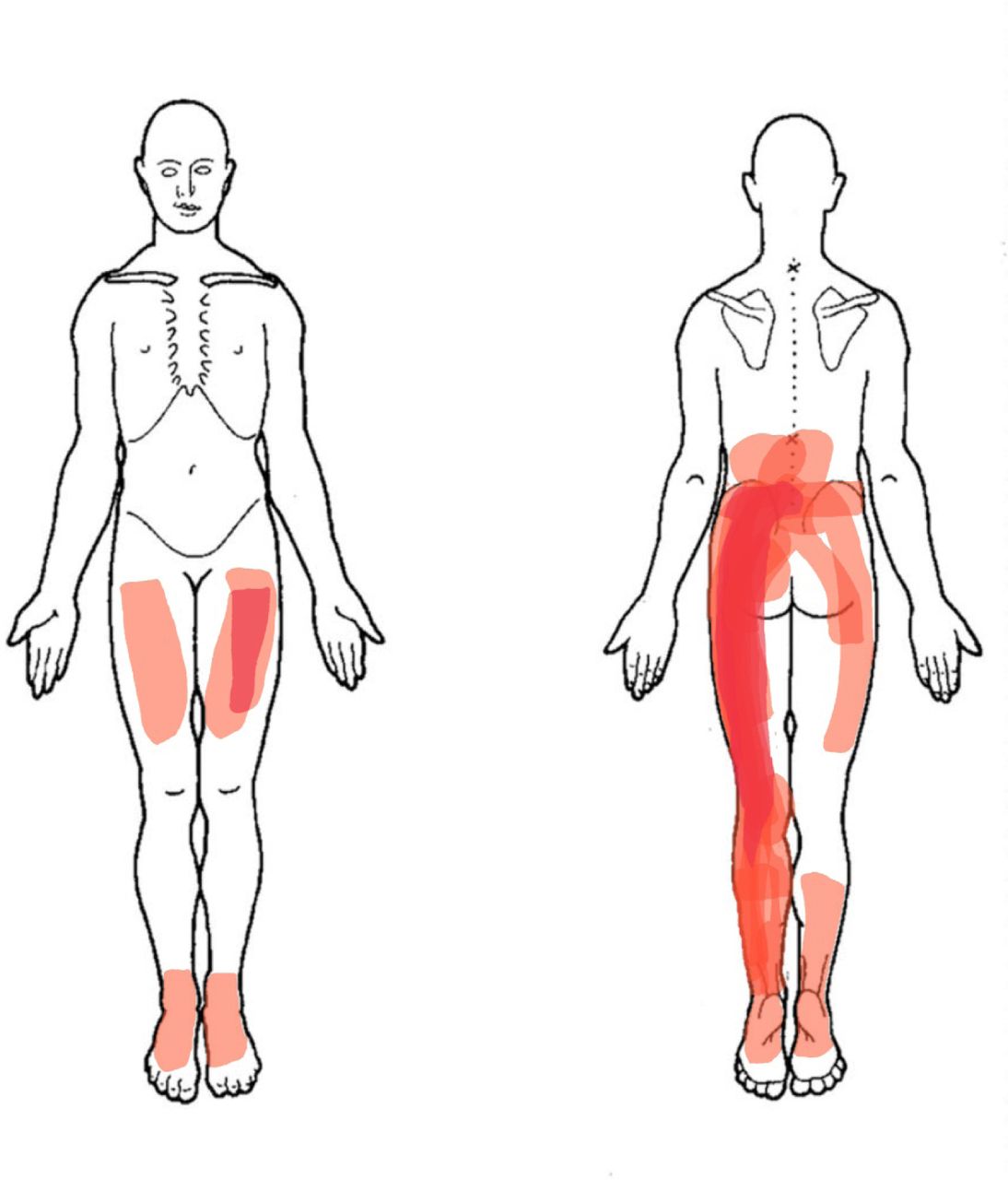 Dor nas costas irradiando para a virilha e abdômen: causa e tratamento