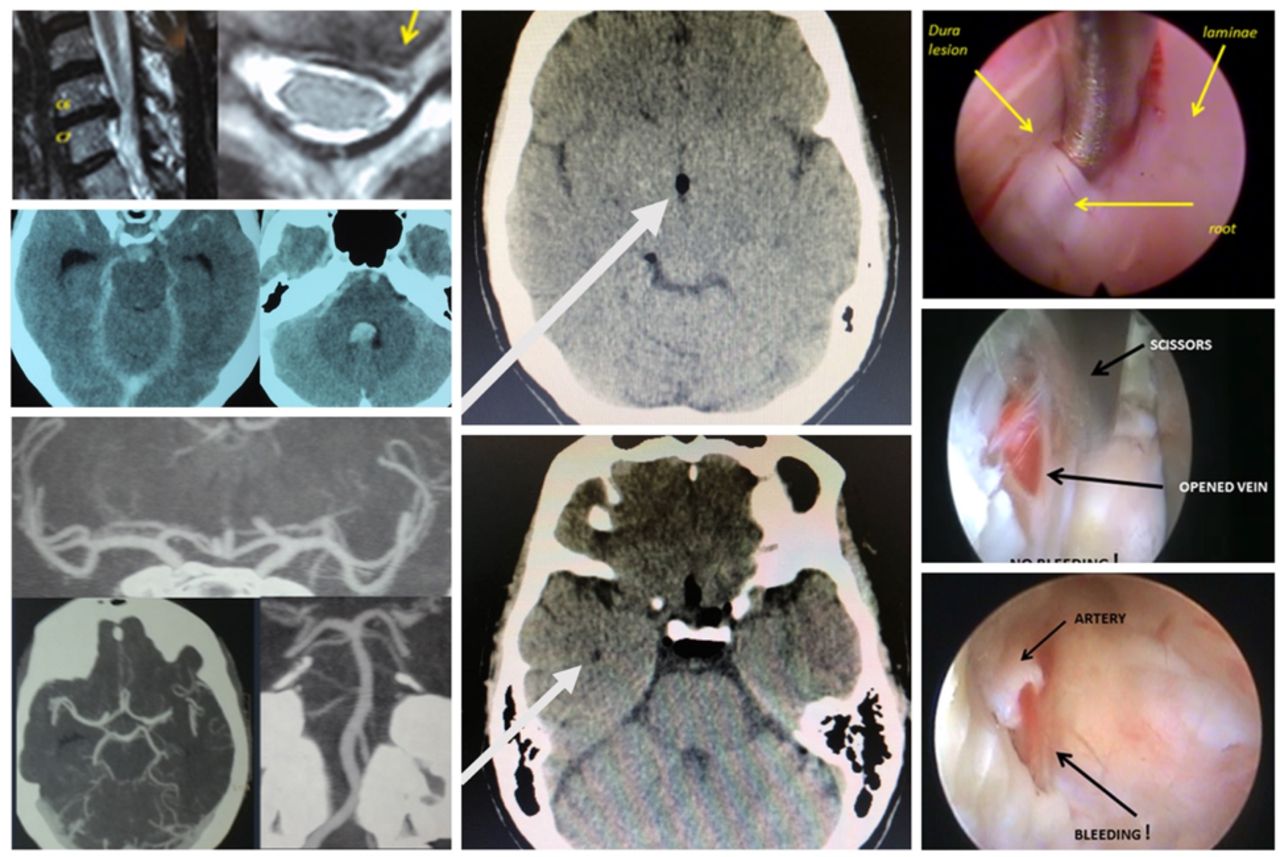 Spinal Stenosis - Nashville Neurosurgery Associates