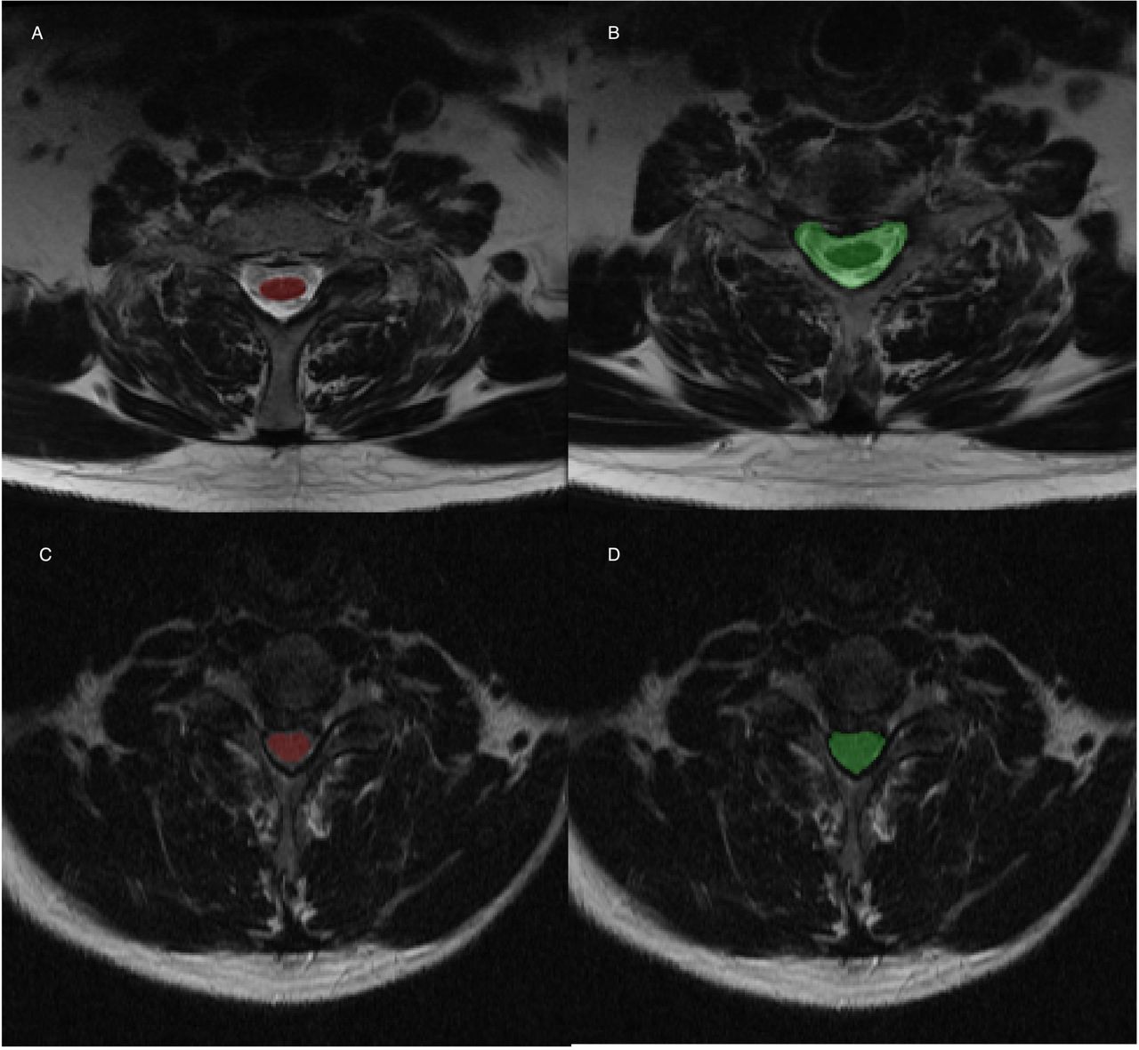 Segmentations of the cervical spinal cord (red) and cervical spinal column (green) generated automatically using our machine-learning model on magnetic resonance images.