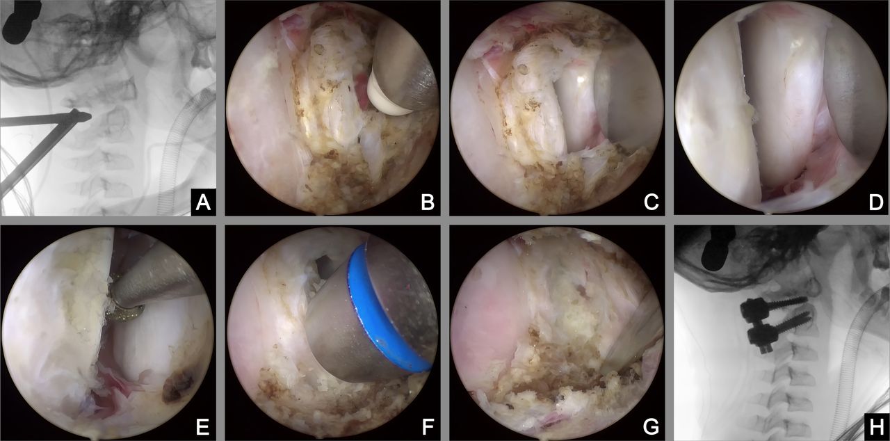 one-hole split endoscopy for posterior atlantoaxial lateral mass joint fusion
