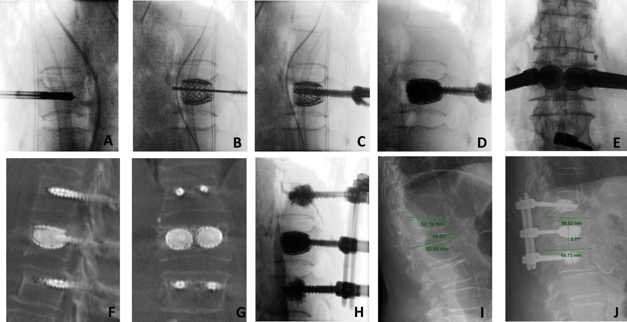 Intraoperative images of screw-assisted internal fixation